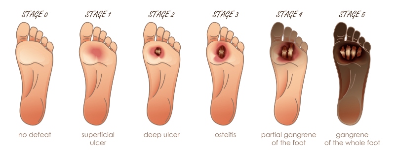 Stages of Diabetic Foot Ulcer chart- Southern Delaware Foot and Ankle