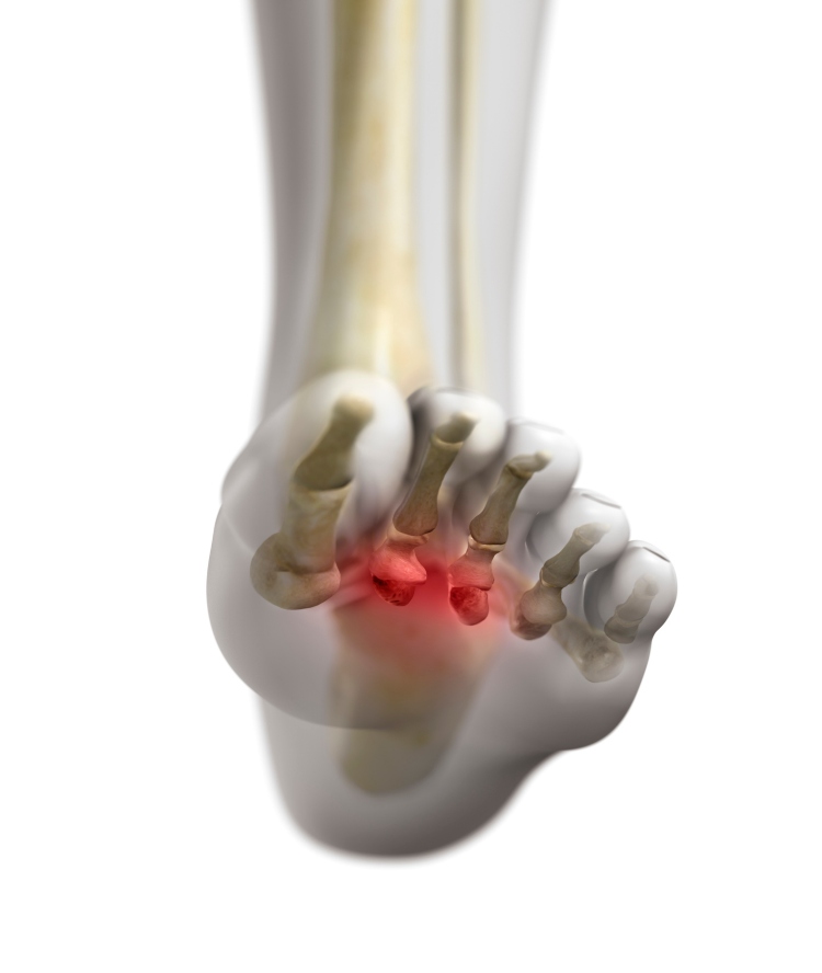 Patient Undergoing Haglund's Deformity Treatment in Millsboro and Seaford, DE