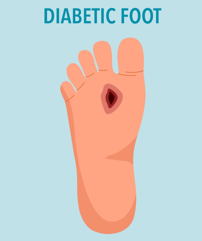 Diabetic Foot Treatment in Millsboro & Seaford, DE