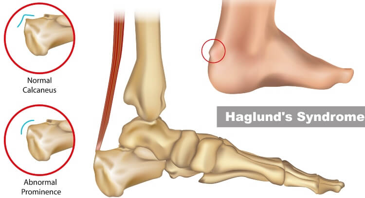 Haglund's Deformity Treatment in Millsboro and Seaford, DE