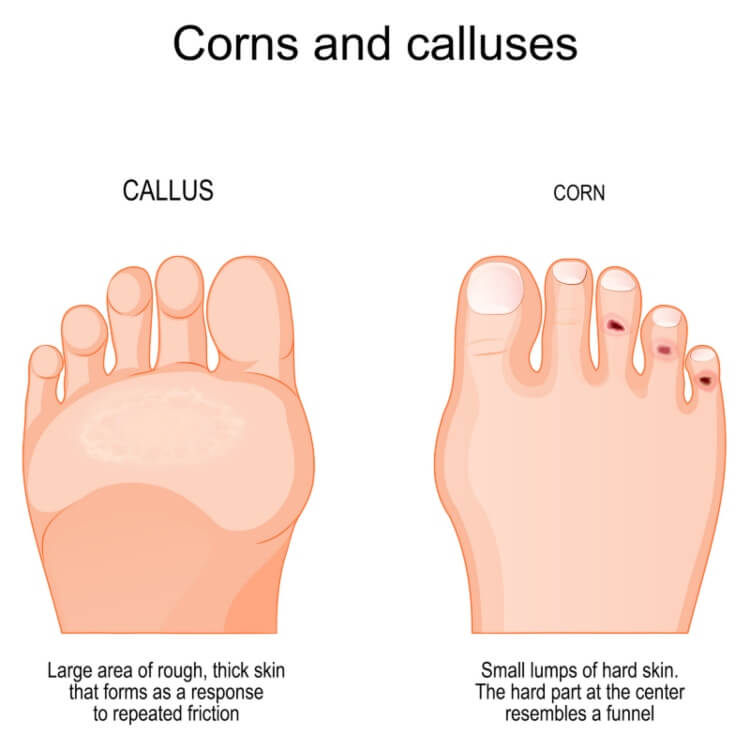 Difference Between Corns Vs. Calluses, Southern Delaware Foot & Ankle