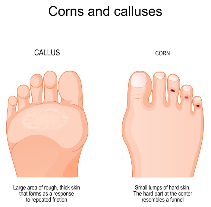 Difference Between Corns & Calluses in Delaware