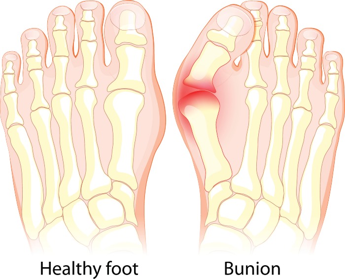 Difference between Bunion and Healthy Foot