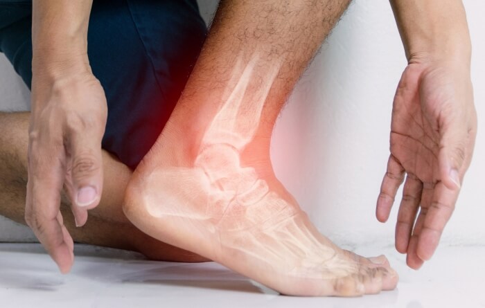 Patient with a Broken Ankle - Get Treated at Southern Delaware Foot & Ankle