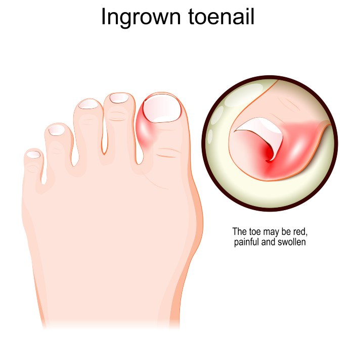 Image explaining Ingrown Toenail - Southern Delaware Foot & Ankle