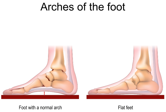 Difference Between Foot Normal arch & Flat Feet, Southern Delaware Foot & Ankle