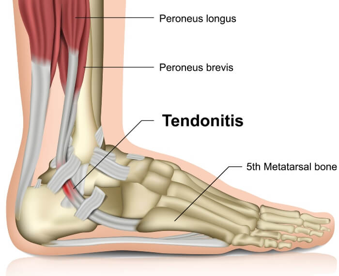 Understanding Tendonitis - Treatment at Southern Delaware Foot & Ankle