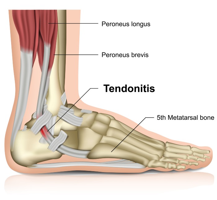 Peroneal Tendon Ankle Joint- Southern Delaware Foot & Ankle