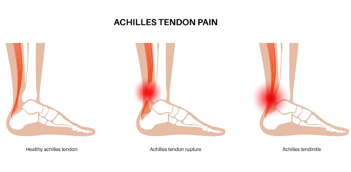 Explaining Achilles Tendon Pain- Southern Delaware foot & Ankle