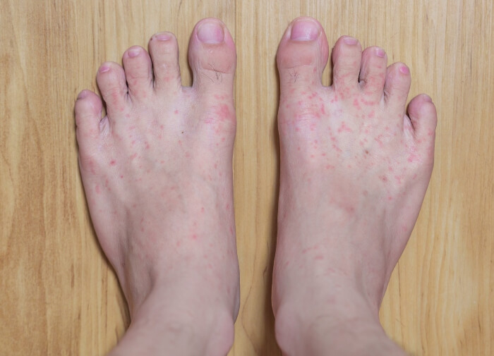 Foot Infection Signs - Redness, swelling  & Itchiness