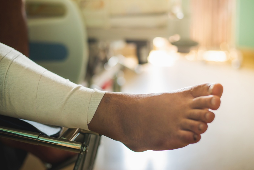 Ankle Fusion Surgery