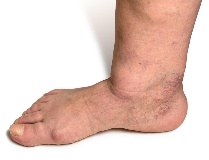 Person in Millsboro, DE, displaying a swollen, injured foot with extra skin