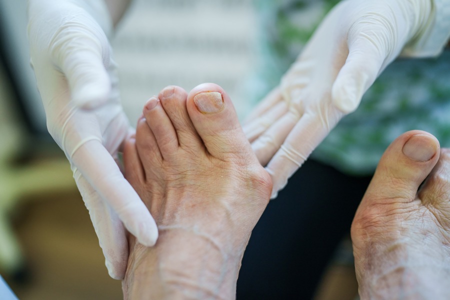 Medical Professional Inspecting a Patient’s Bunion as Part of Treatment in Seaford & Millsboro, DE